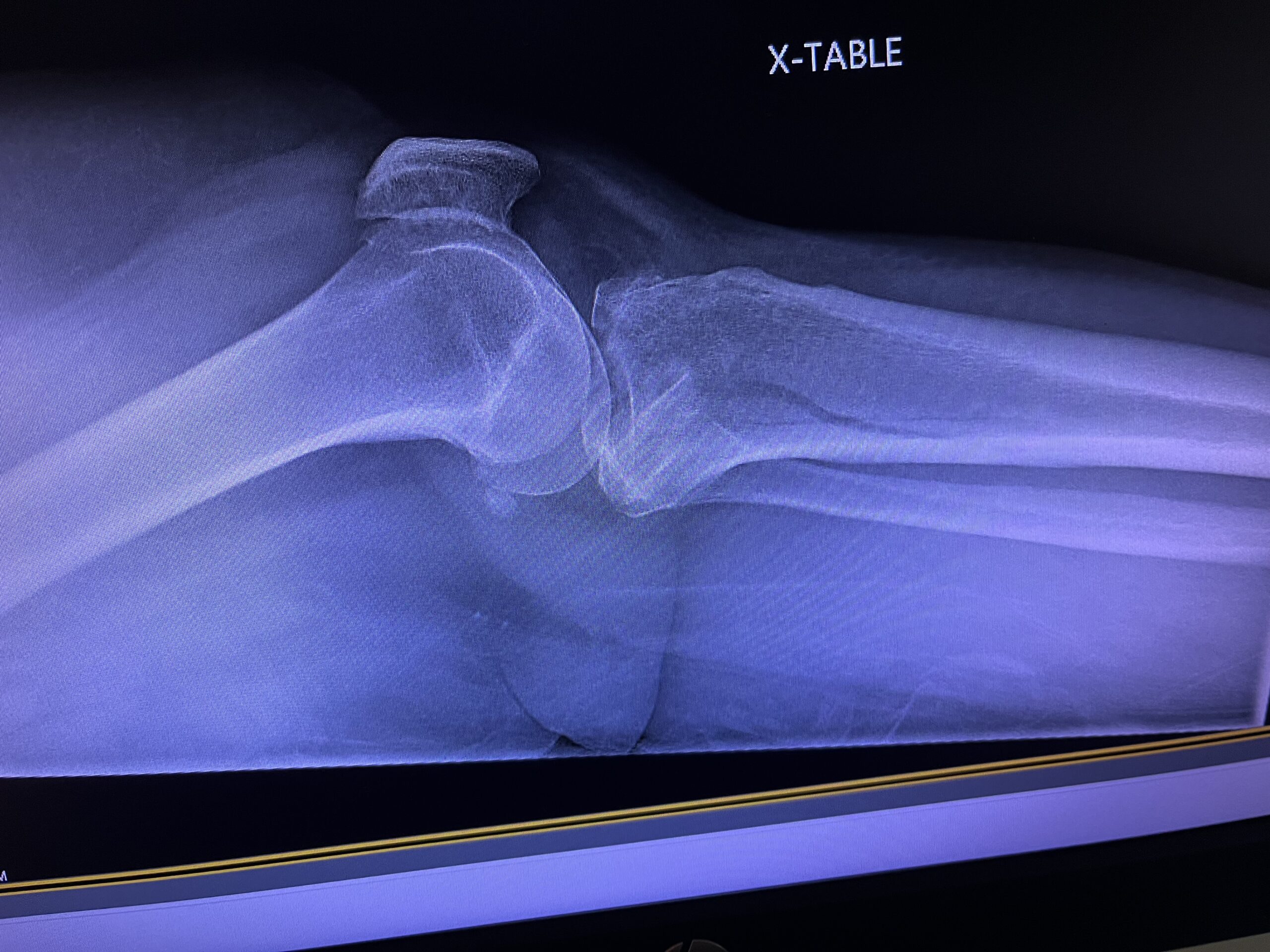 tibial plateau fracture